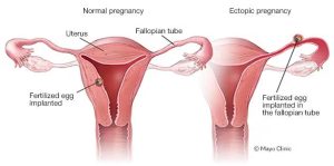 diagram showing an ectopic or tubal pregnancy versus a normal pregnancy